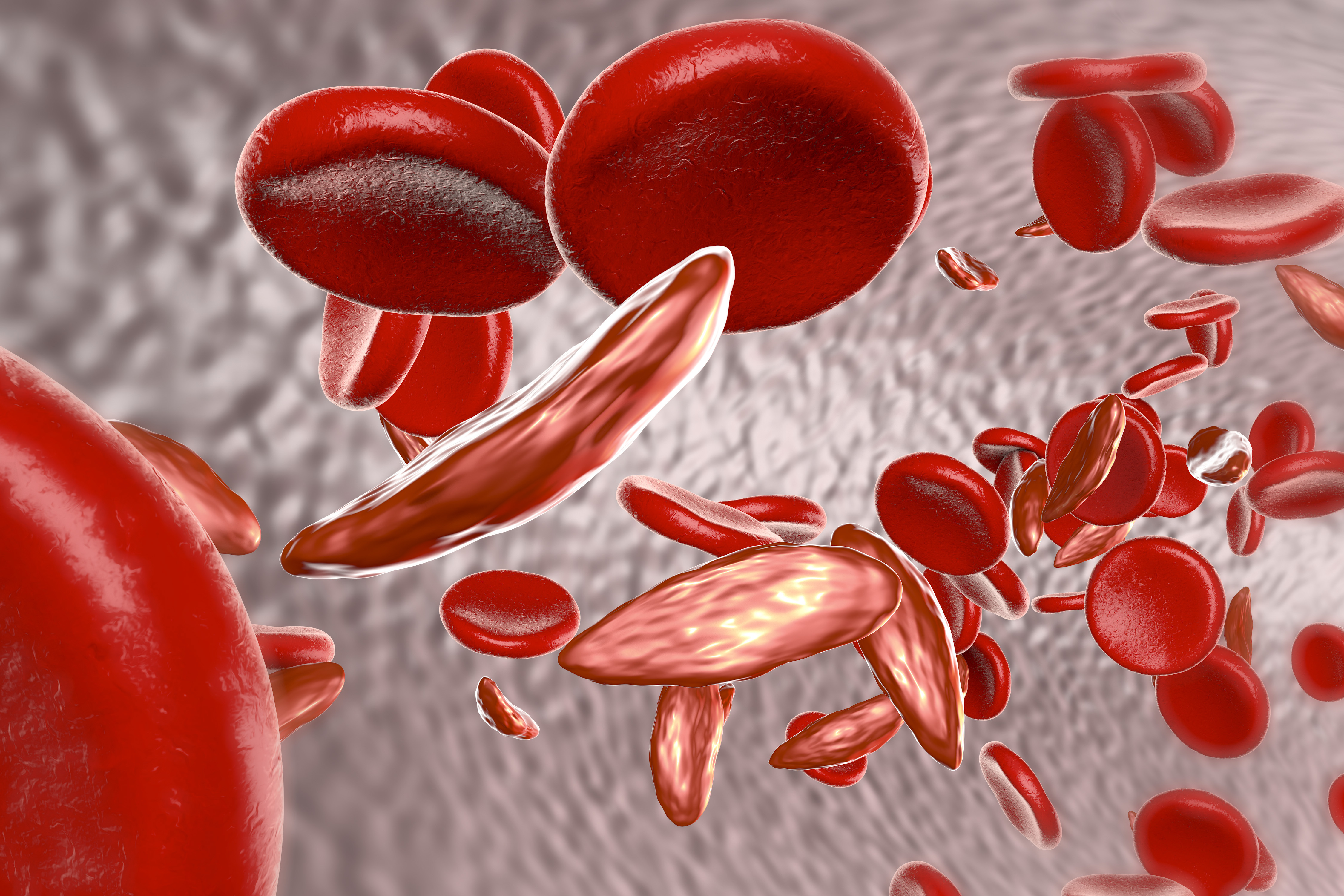 Анемия количество эритроцитов. Серповидно-клеточная анемия (s-гемоглобинопатия). Серповидноклеточная анемия эритроциты. Талассемия и серповидноклеточная анемия. Серповидно-клеточная талассемия.