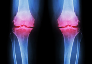 rendgenski liječenje osteoartritisa 39 tjedna bolova u kukovima